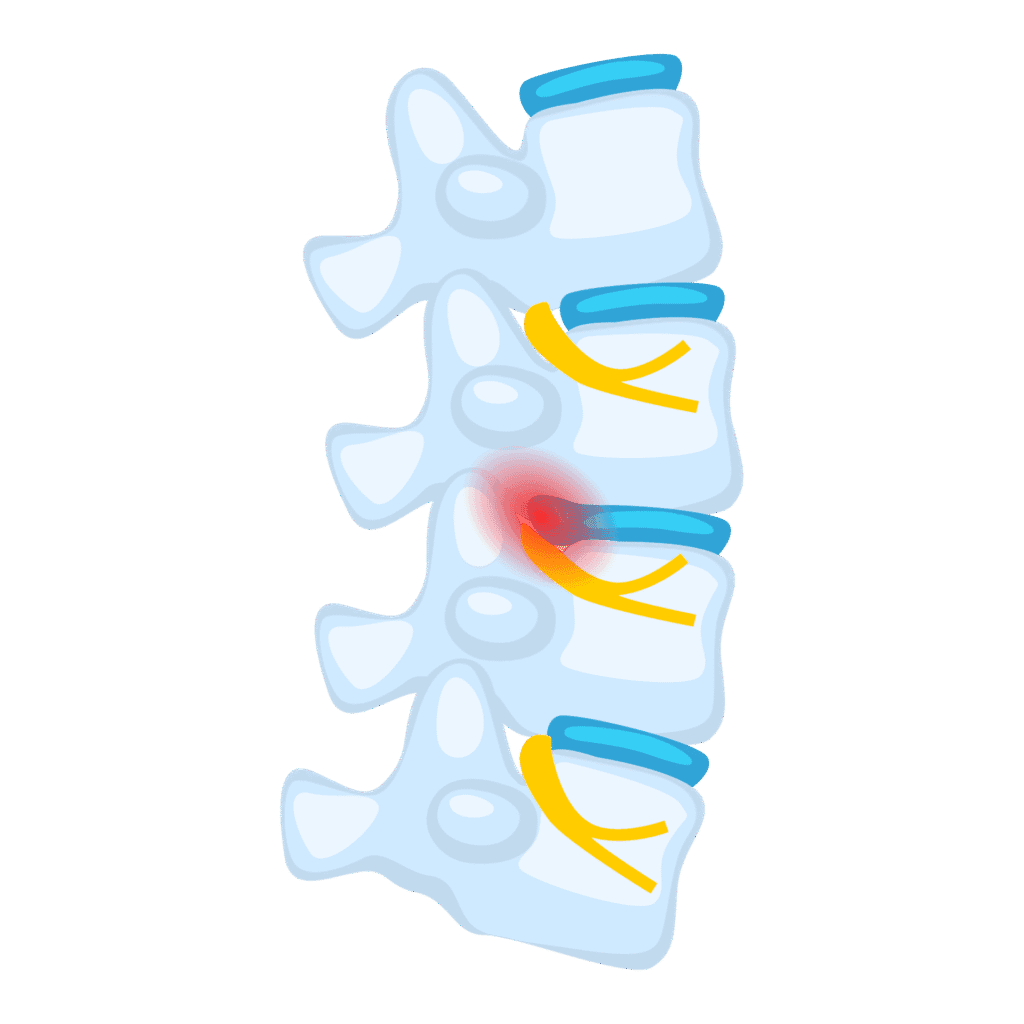Illustration of a spine with a highlighted area showing a herniated disc or back pain.