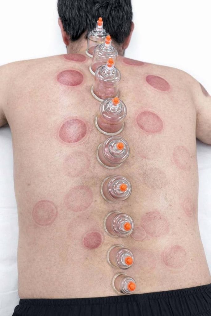 Cupping therapy marks on a person's back, showing circular bruises and suction cups used for muscle tension relief.