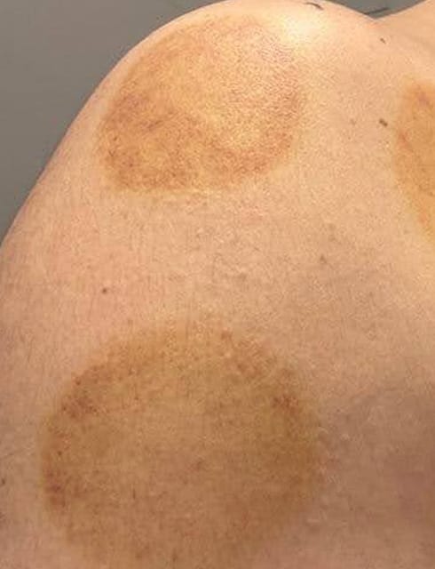 Cupping therapy marks on a shoulder, showing circular bruises from the treatment.