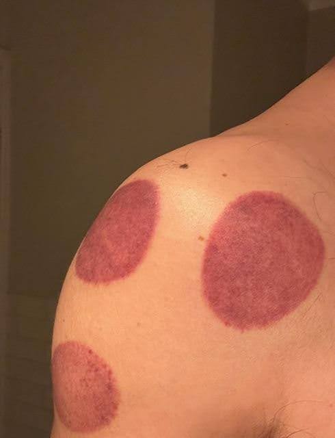 Cupping therapy marks on a person's shoulder showing circular bruises from suction treatment.