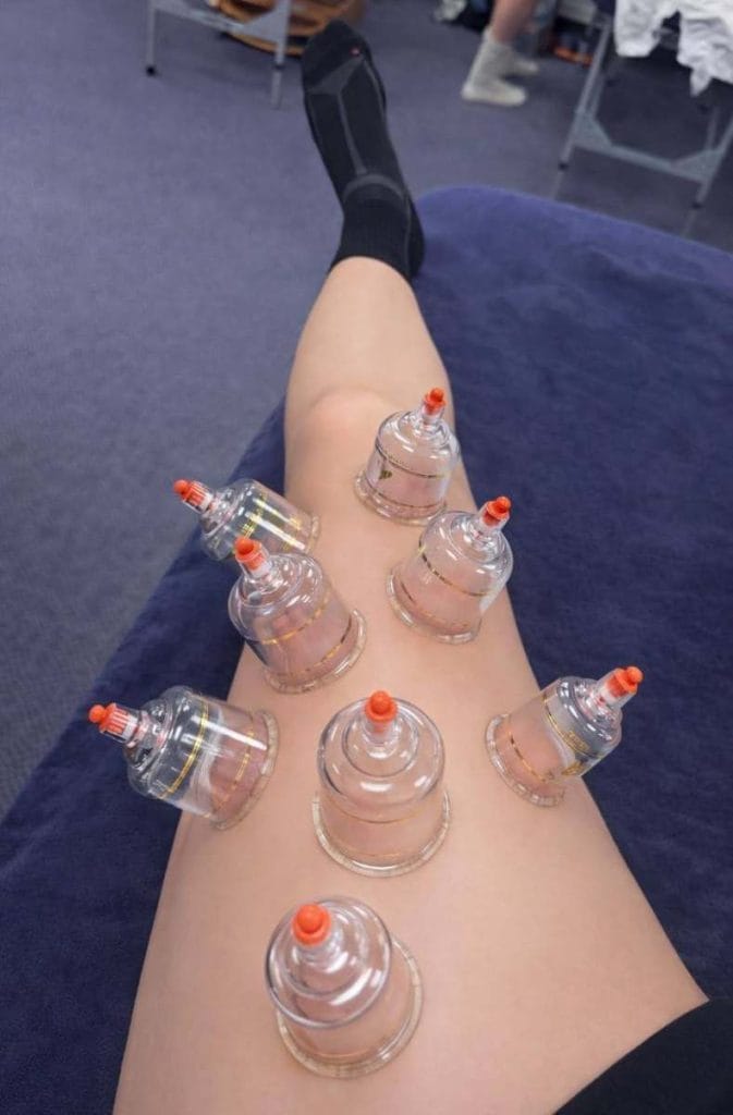 Cupping therapy treatment with cups placed on a person's leg for muscle relief.